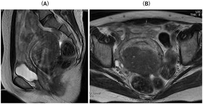 Case Report: The first case of successful pregnancy and live birth following laparoscopic resection of adenomyosis under real-time intraoperative ultrasound elastography guidance